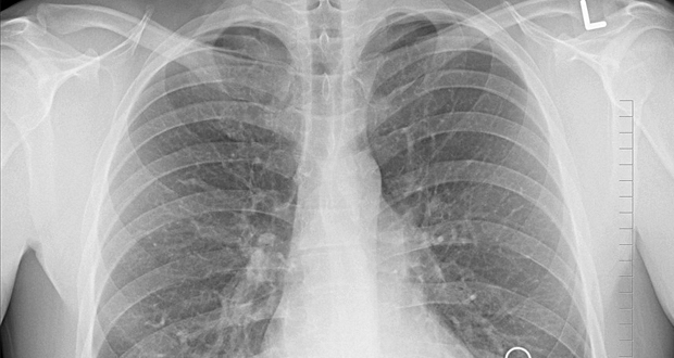 Υπερδιπλασιάστηκε η μέση συνολική επιβίωση για ασθενείς με καρκίνο του πνεύμονα
