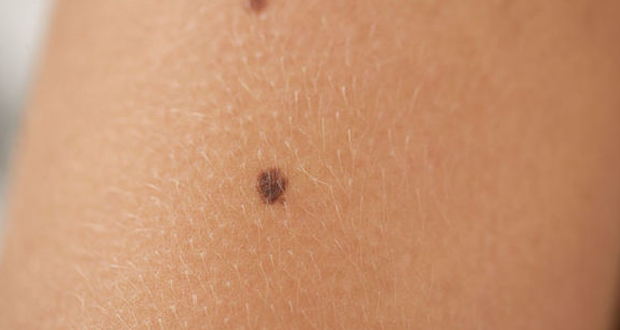 Πώς να προλάβετε τον καρκίνο του δέρματος και το μελάνωμα