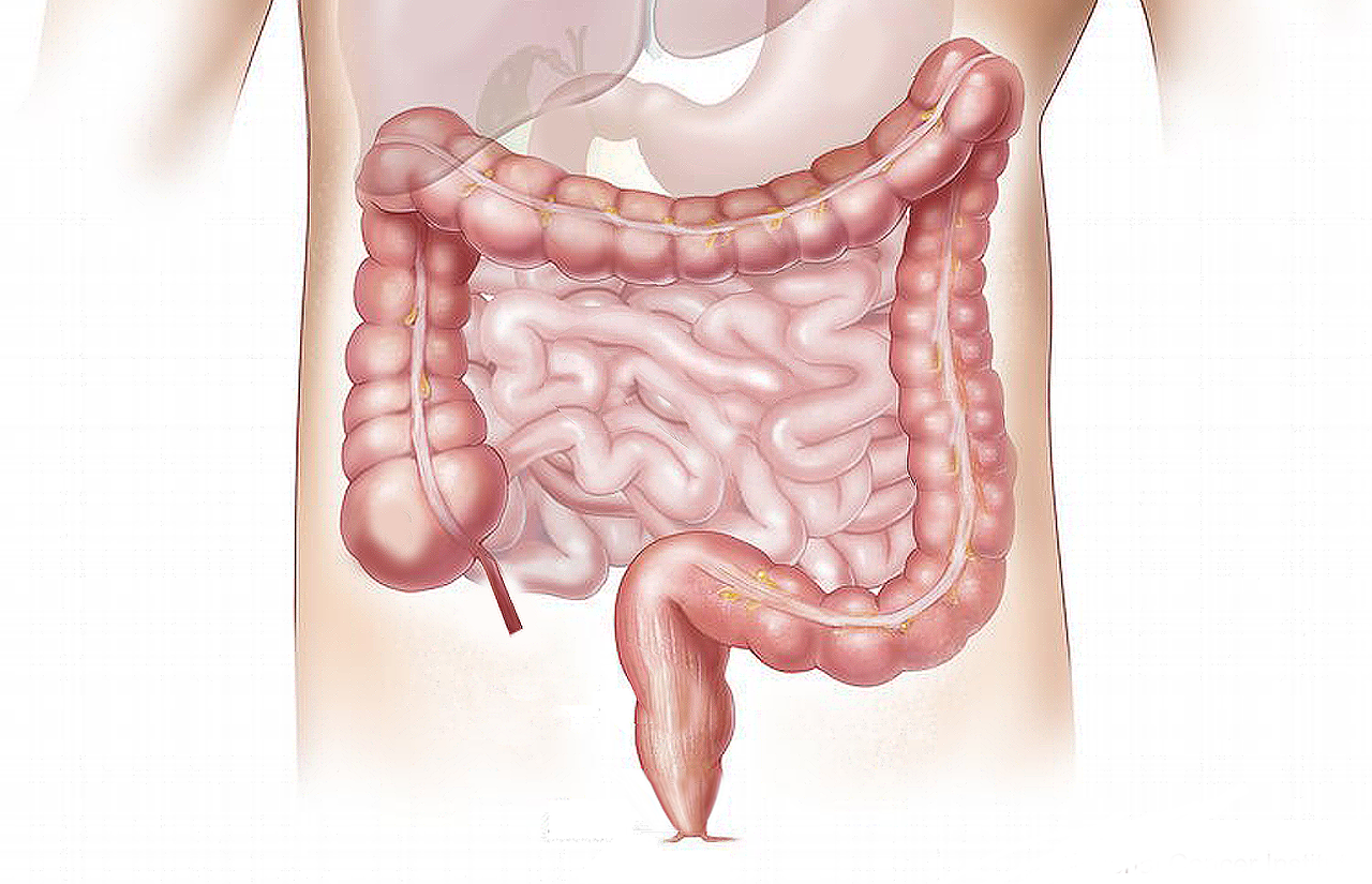Ποια διατροφή προστατεύει από τον καρκίνο του παχέος εντέρου